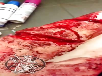 BRAVUCONGX HARD CUTTING MUTILATION