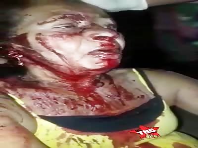 Woman Bleeding After Hit By Car