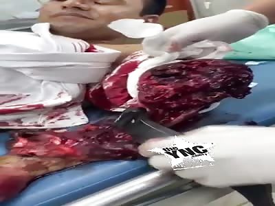 Man With Amputated Forearm is Fully Awake