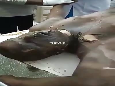 Stayed alive after being burned