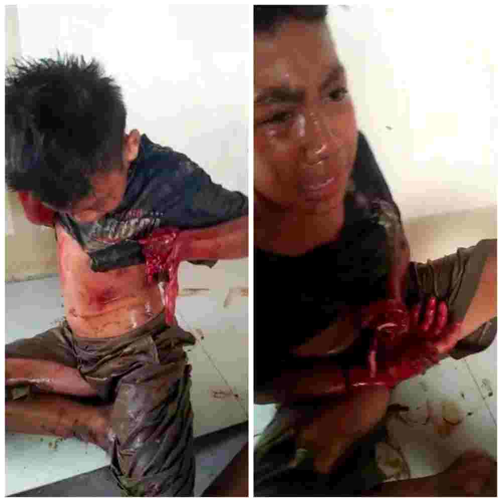 Dude Loses Fingers In Fireworks Failure