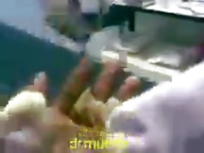 Third degree burns in hand