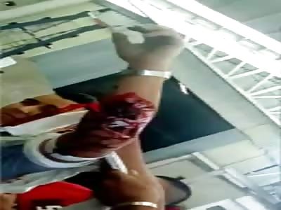 Horrible injury work accident