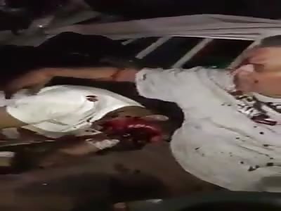 Strong accident leaves a man very badly injured and with the leg undone