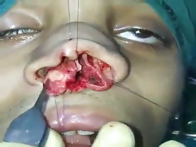 nose surgery rhinoplasty