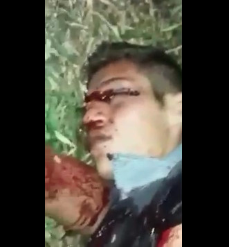 Man Shot in the Face Agonizes and His Brain Exposed through The Exit wound