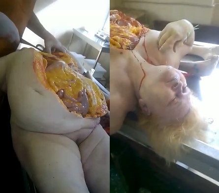 Clip of Autopsy on Obese Woman