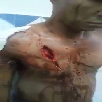 Man with open chest after bombing attack in Iraq