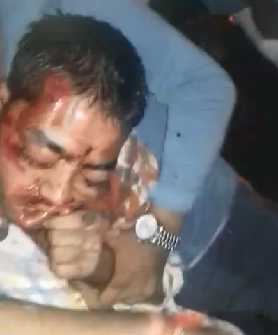 No Ambulance They Try to Take the Guy to Hospital on a Moped