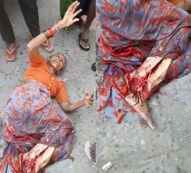 Elderly lady foot destroyed by truck 