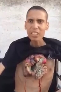 Man's Chest Split Open has Horrific Tumors Caused by Cancer