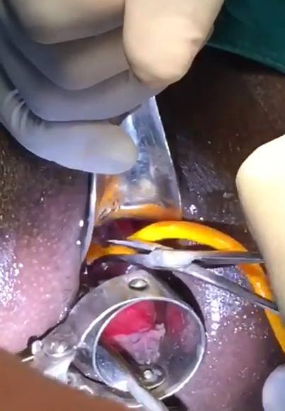 BIG Surprise Removed From Man's Ass