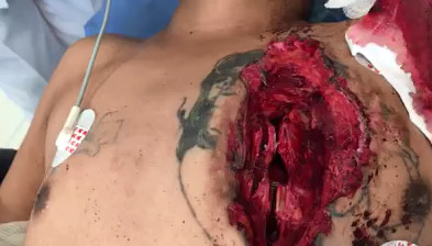 Horrible Chest Trauma (Exposing Heart Beating) 