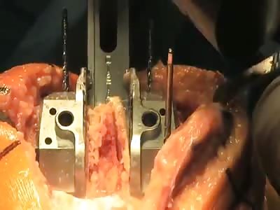 Surgery to Replace Knee