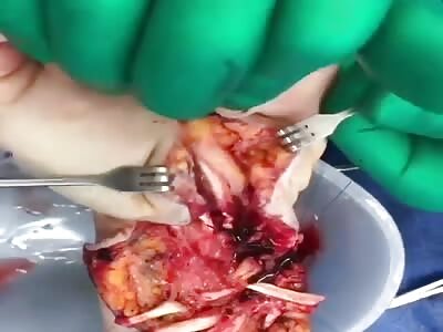 Tendons Of The Hand.