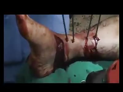 survivor to a bomb with serious injuries