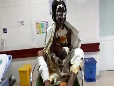 wtf fully burned body