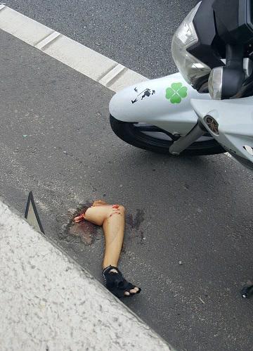 Man has Arm Torn off of Shoulder Blade...Still Alert and Alive 