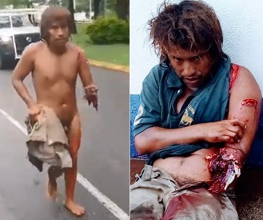 Alligator Rips Off Homeless Man's Arm {Full Video}