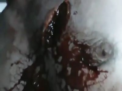 Allah snackbar chest injury