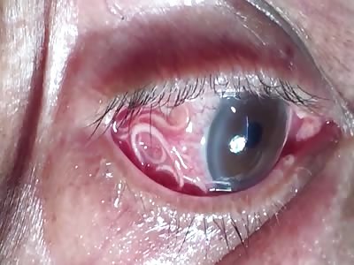 15cm - long parasitic worm