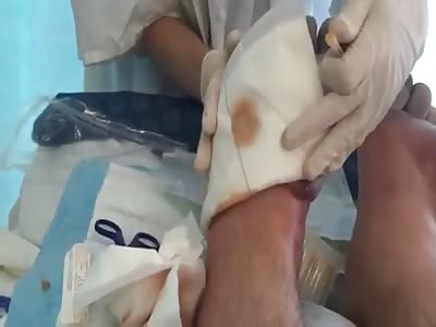 Frostbitten Feet Get Worked On 