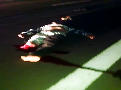 acciden leg amputation