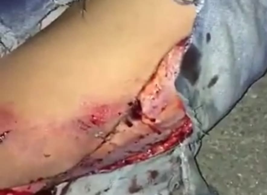 Nice Little Gash After Bike Accident