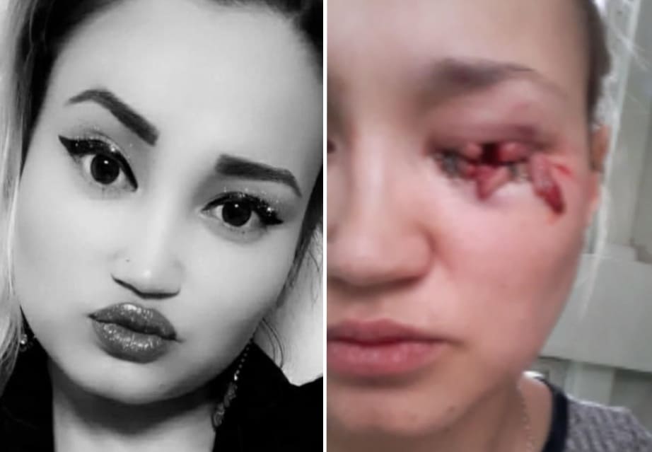 Woman Damn Near Loses Eye to Stray Dog