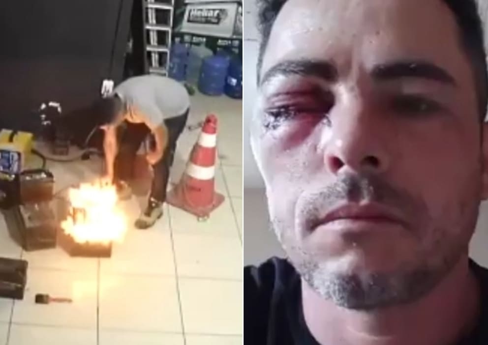 Mechanic Loses Eye When Car Battery Explodes