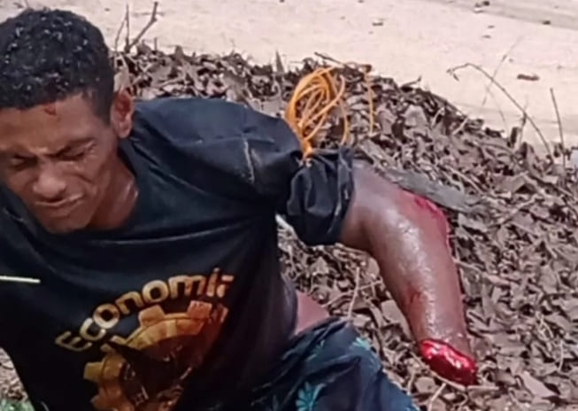 Mans Hand Severed in Machete Attack