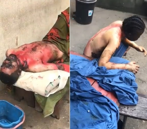 Woman Sets Ex On Fire, Gets Burned In The Process