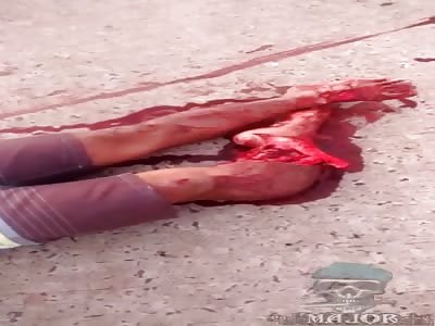 man with broken leg in accident