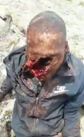 Accidental Firearm Discharge Leaves Man with Hole Across His Face