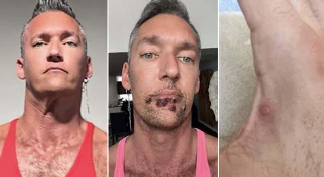 Man With Monkeypox Says Just Being Awake Is Excruciating!