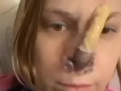 Cocaine and Meth Addiction Ate Her Nose off.