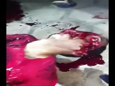 Mans Eye Popping Out Who was Shot in the Face