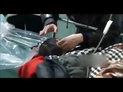 6 Year Old boy Has Flat Steel Bar Stuck Through his Head