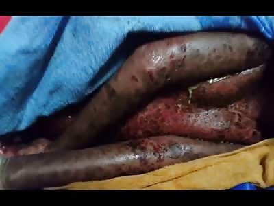 Poor Kid with Horrific Lizard-Like Skin Disease 