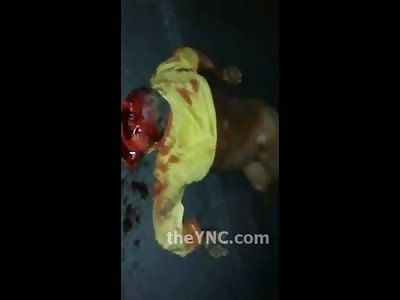 Man left Unrecognizable after Traffic Accident Leaves Him Legless and Faceless 