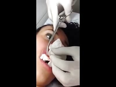 Girl with a Fat Upper Lip Finds Out Why and its NOT Pretty 