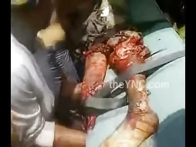 Mans Legs Completely Fucked Up 