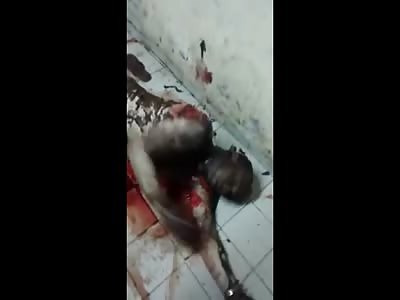 Poor Man Just Wanted a Drink at a Bar Ends up in Agony Burned From Head to Toe