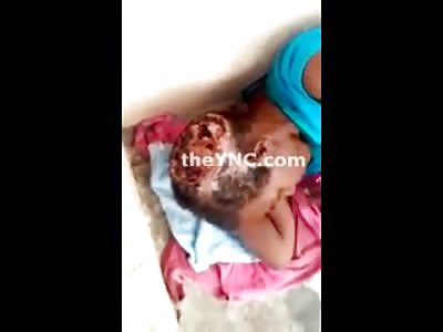 Horrible: Mentally Ill Homeless Woman has a Gruesome Infestation of Maggots on her Head 