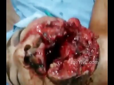 Man Has his Mouth Blown Off