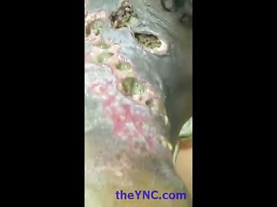 Zombie Man is a Live Feeding Ground for Maggots Living in his Back 