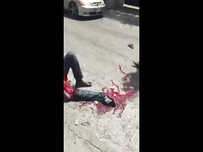 Jamaican Man with his Femur Bone coming out of his Leg Sits in Hopelessness 