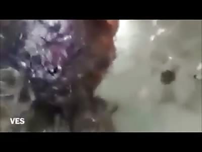 Homeless Man With Rotten Wound in the Head Infested of Maggots