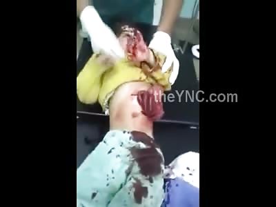 Poor Little Kids Insides Exposed after Terrorist Bombing