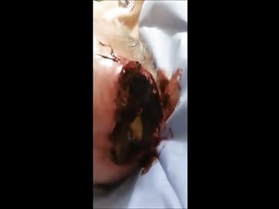 Elderly man with wound in the head w/ maggots
